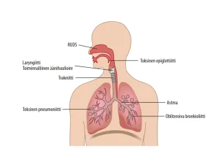 Piirroskuva ihmisen ylävartalosta, jossa esitetty hengitysteitä voimakkaasti ärsyttävien aineiden vaikutukset: RUDS, laryngiitti, trakeiitti, toksinen pneumoniitti, toksinen epigottiitti, astma ja obliteroiva bronkioliitti
